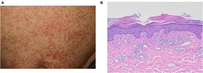 Case report: Clinical features of COVID-19 vaccine-induced exacerbation of psoriasis–A case series and mini review